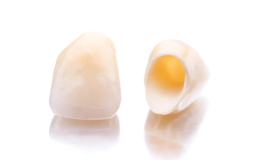 Why Crown and Bridges Are Reliable Options for Dental Restorations