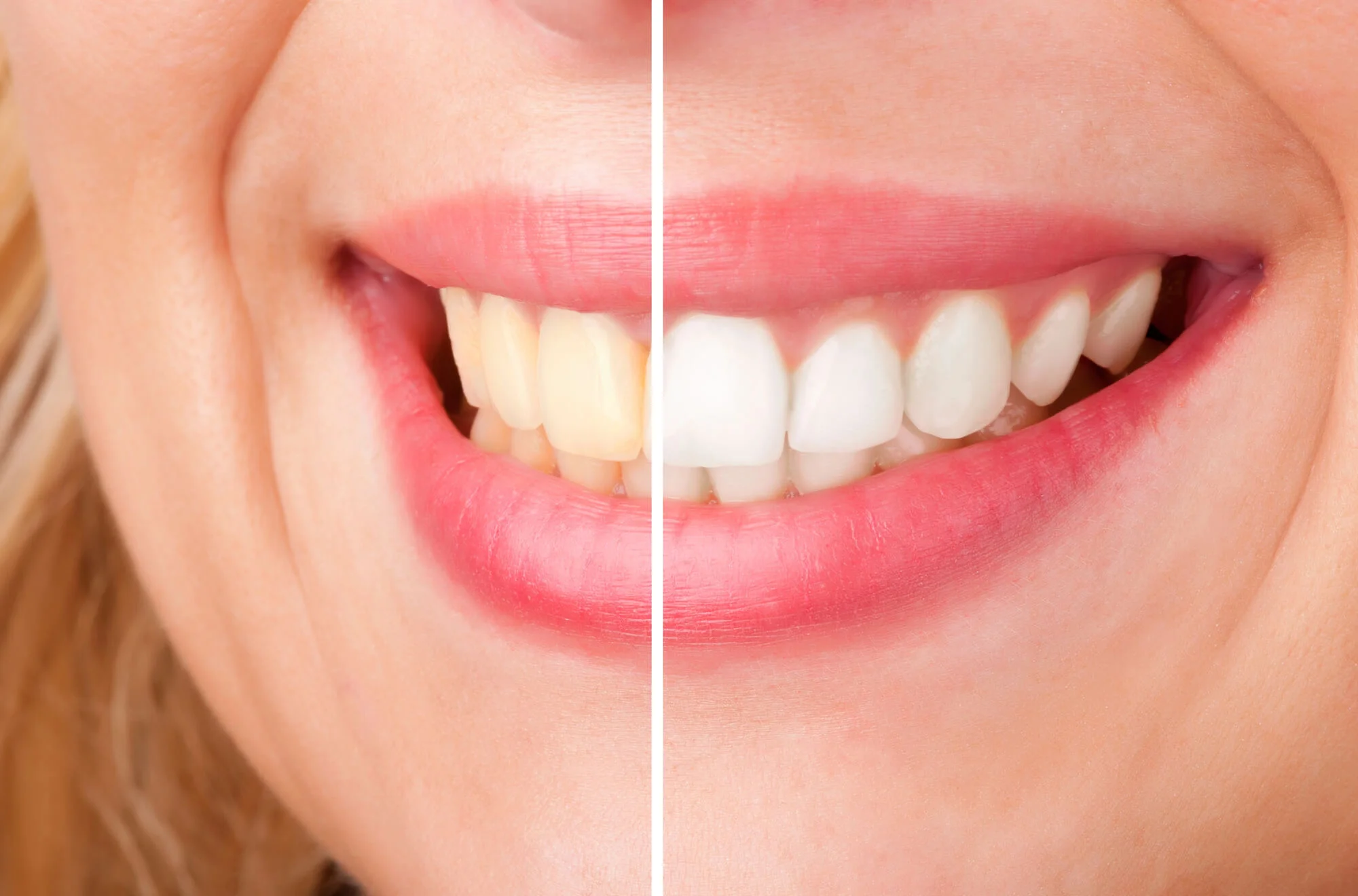 Before after teeth whitening Dentist near Edison, New Jersey.