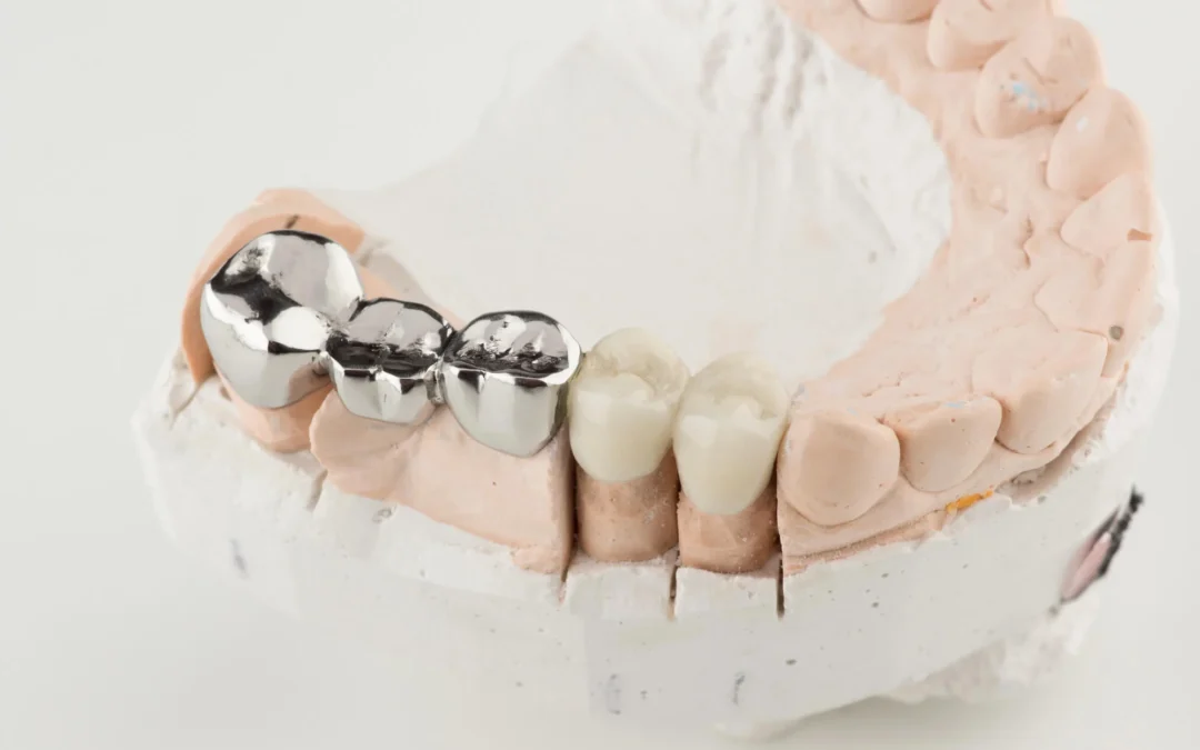 Why Ignoring Damaged Teeth Can Lead to Bigger Issues