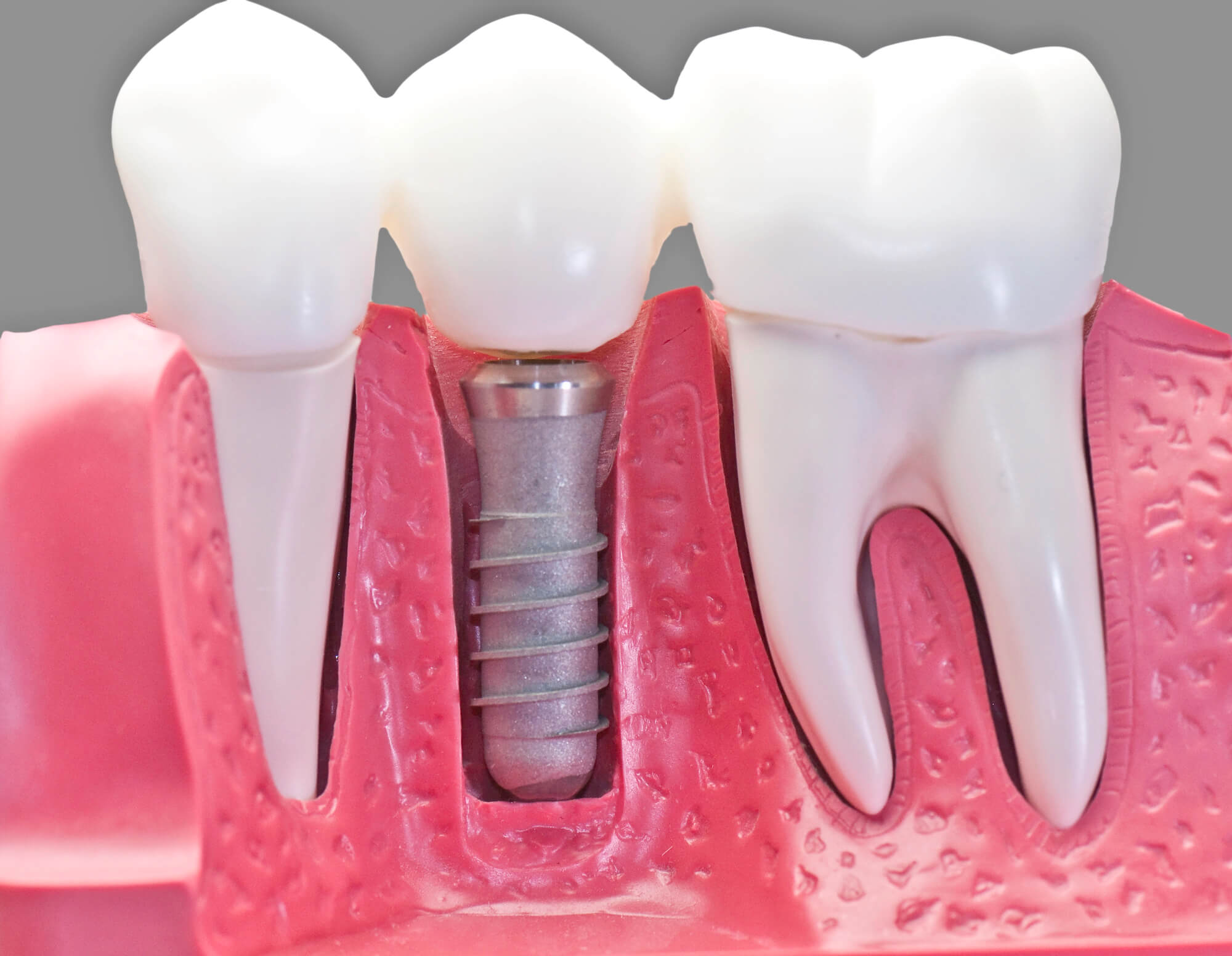 Close-up of dental implants in New Brunswick, NJ